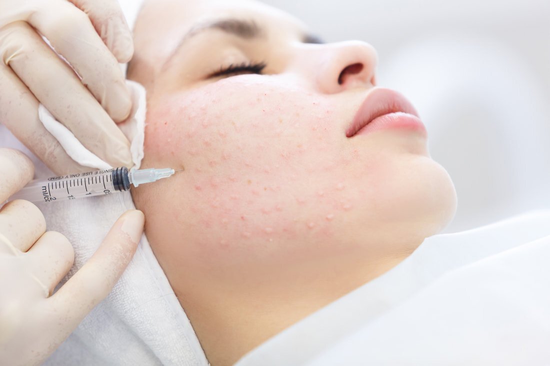 Benefits of Mesotherapy for the Face